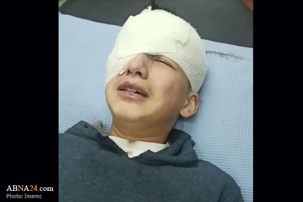 Palestinian child loses his eye by occupation bullet in Al-Khalil